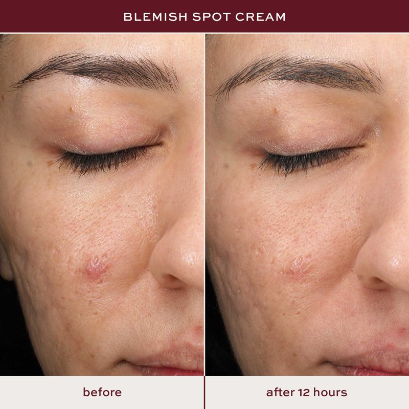 Blemish Acne Spot Treatment with 0.5% Salicylic Acid and Tea Tree Oil, 0.5 oz