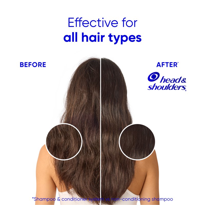 Coconut Dandruff Conditioner for Hydration & Flake Control - 10.9 fl oz