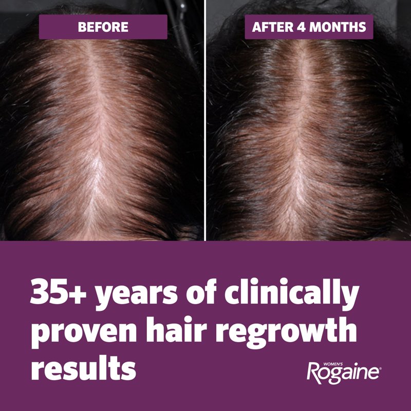 Minoxidil 5% Hair Regrowth Foam for Women, 4-Month Supply, 2 x 2.11 oz