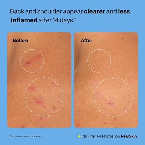 Peach Slices - Breakout Banisher Body Spray (4 oz) - 1% Salicylic Acid, Glycolic Acid - Clear & Prevent Body Breakouts - Niacinamide, Beta-Glucon, Aloe - Vegan, Cruelty Free, Korean Skin Care & Beauty
