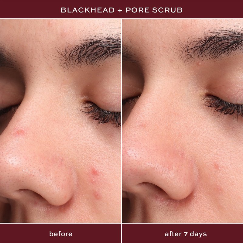 Exfoliating Pore Scrub with Salicylic Acid for Blackhead Treatment, 0.5 fl oz
