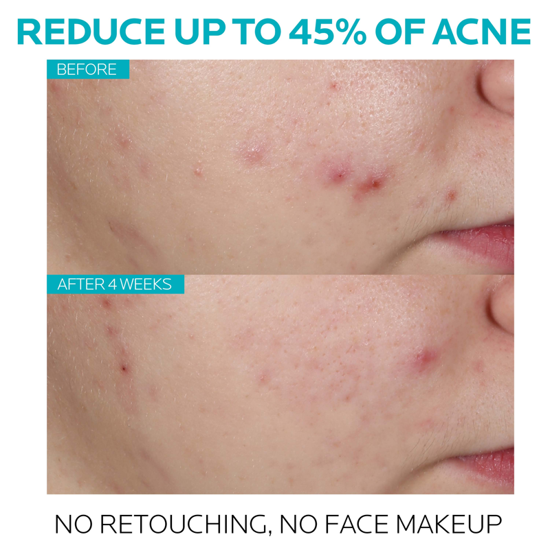 Salicylic Acid Acne Serum with Niacinamide for Clear Skin 1.0 fl oz