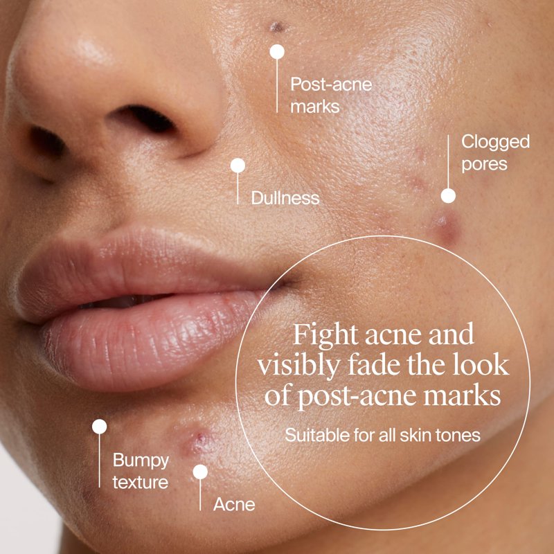 Multi-Acid Acne Exfoliant Serum with 0.5% Salicylic Acid, 1 fl. oz